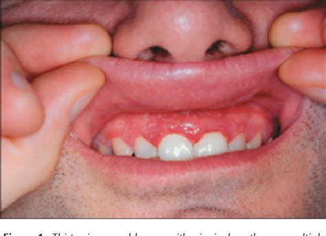 All had no history of herpes simplex virus infection and presented with oral lesions suggestive of primary herpetic infection. . Secondary herpetic gingivostomatitis